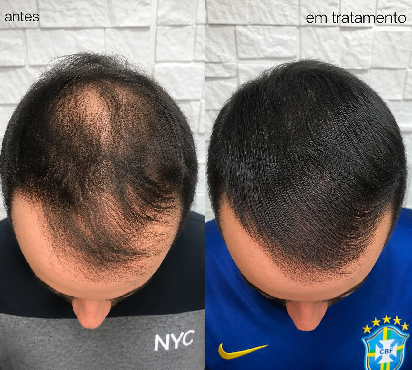 Antes e depois — Terapia Capilar